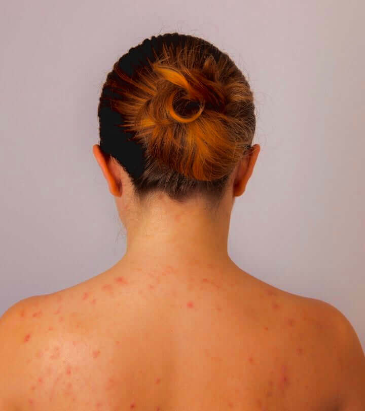 WHAT IS THE BEST BODYWASH FOR PEOPLE WITH BACK ACNE?