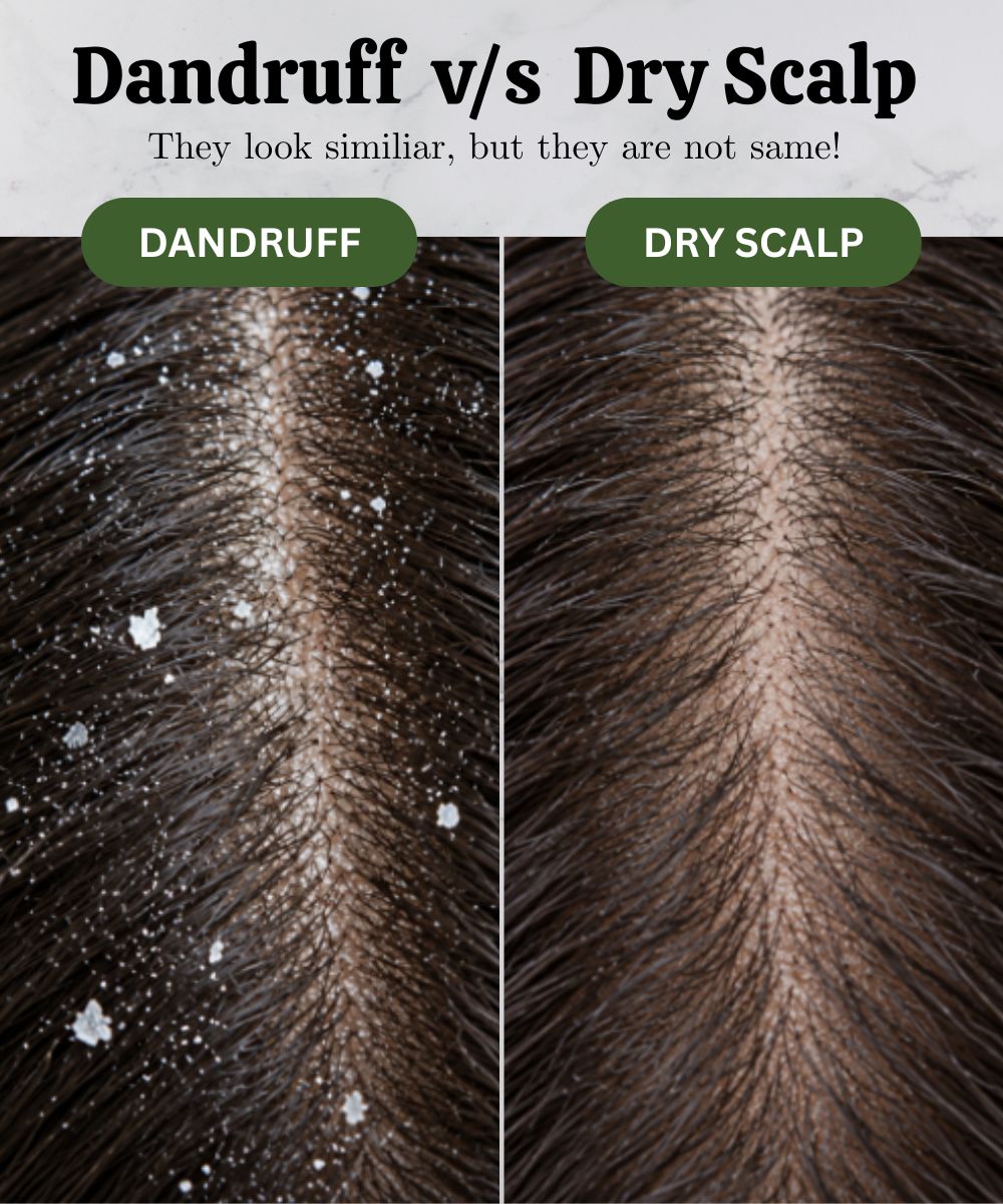 dandruff vs dry scalp