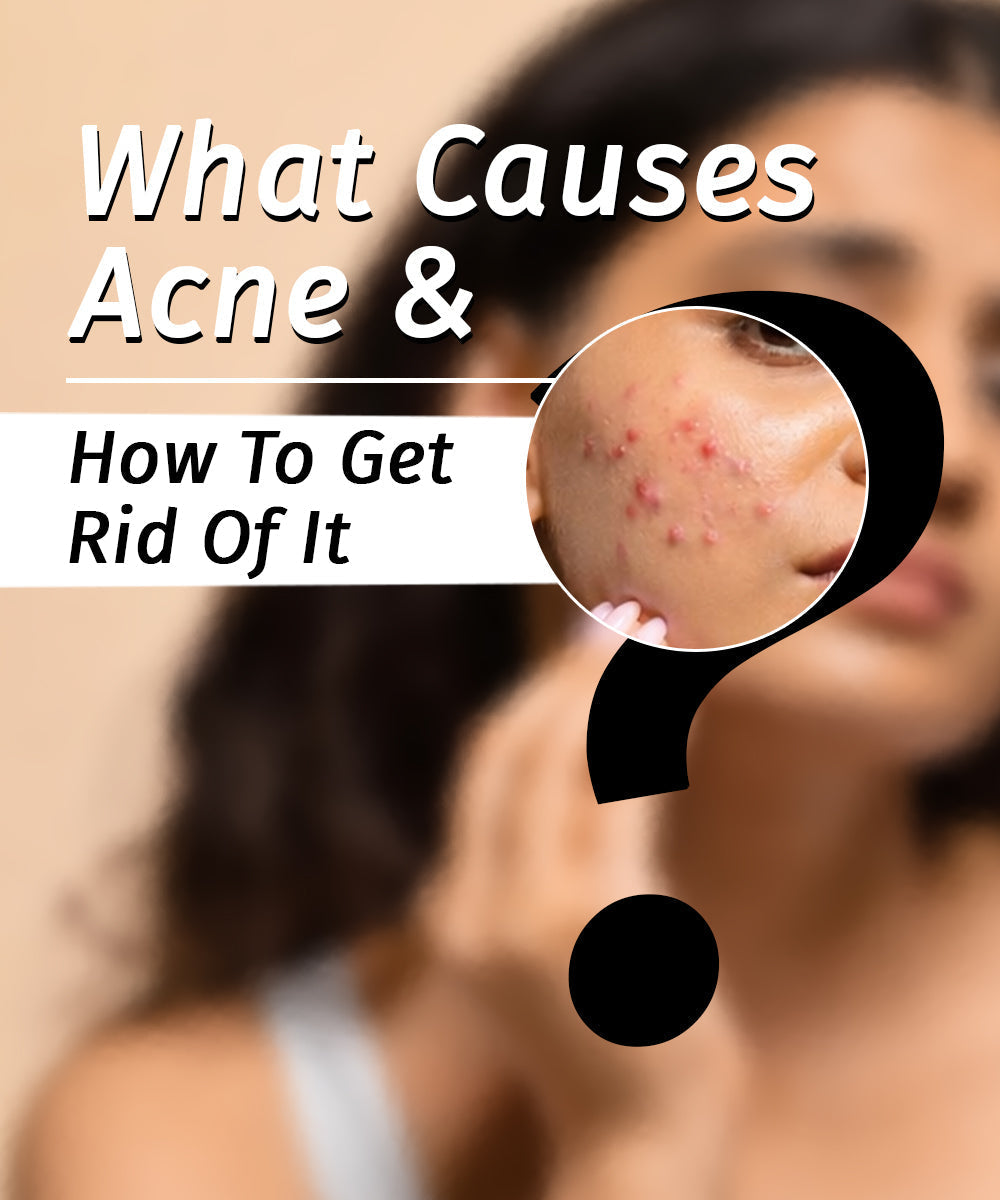 acne causes and how to prevent it