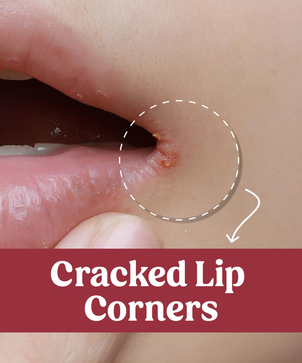 cracked lip corners
