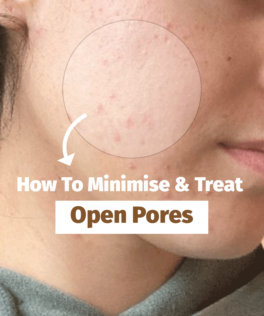 how to treat open pores on face