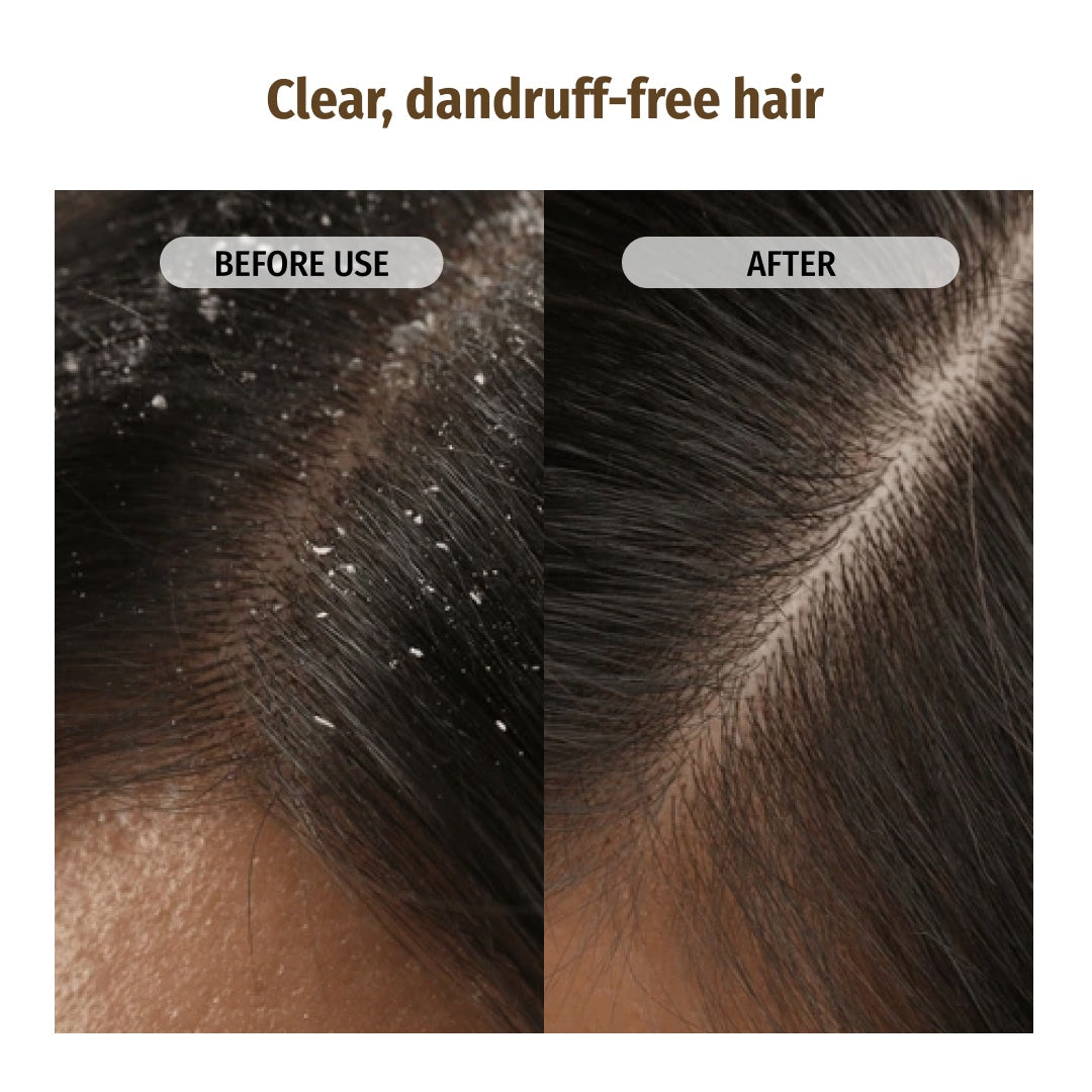 Anti-dandruff Combo