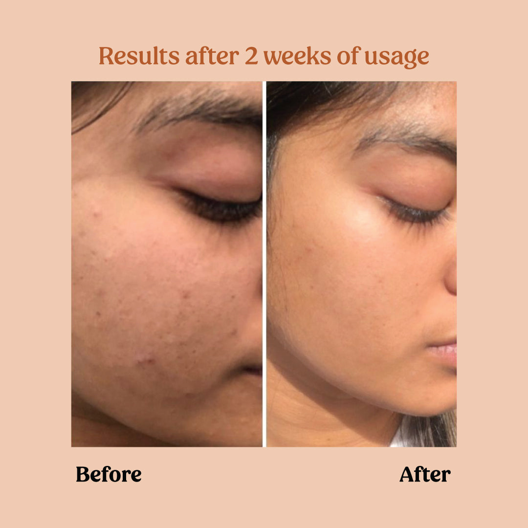 Before and after using milk powder face wash - Vilvah