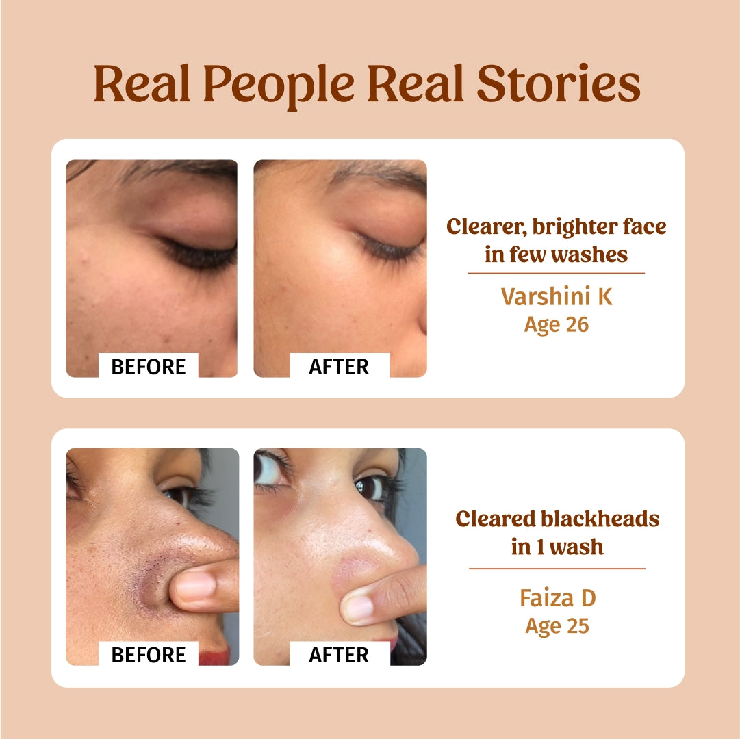 Before and After using Vilvah Milk Powder Face Wash