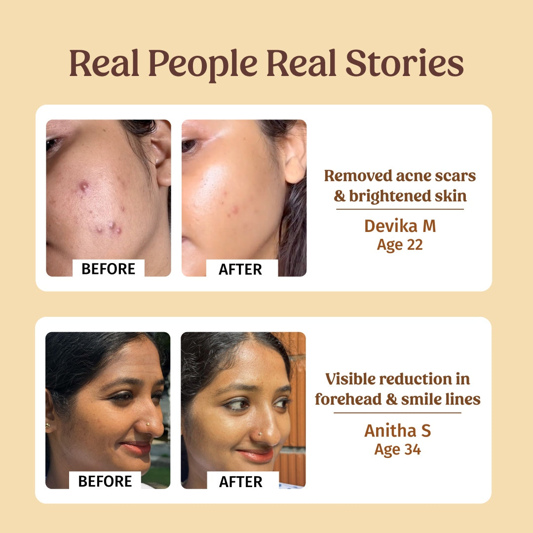 Before and after using Vilvah AM PM Serum Combo