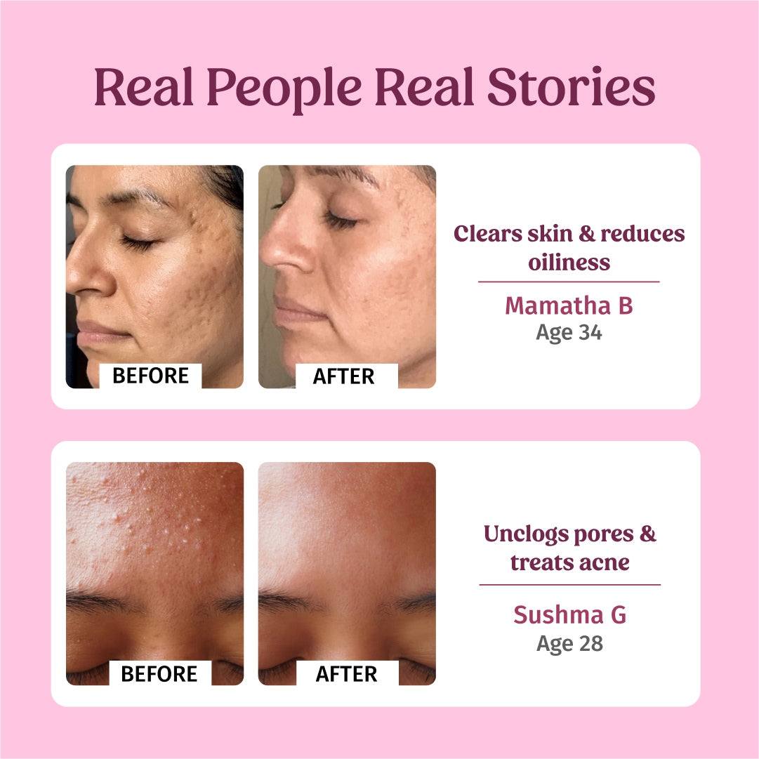 before and after using VIlvah's Rose Water Facial Toner