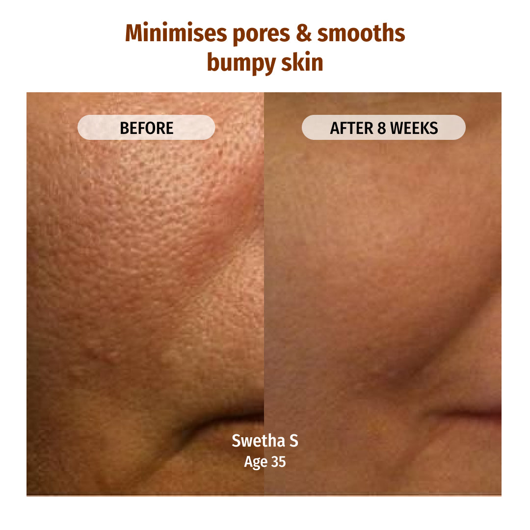 Vilvah Skin Hydration Combo Minimises Pores and Smooths Bumpy Skin
