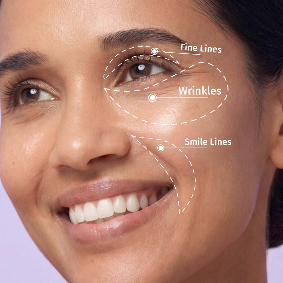 fine lines, wrinkles, and smile lines