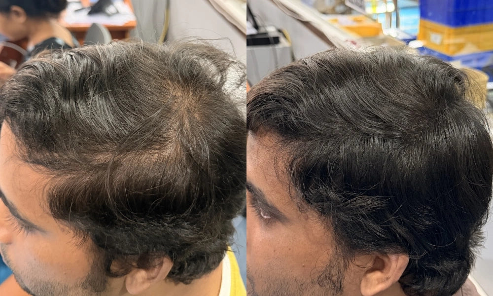 before and after using vilvah hair growth serum