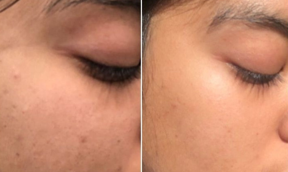 before and after using vilvah skin radiance combo
