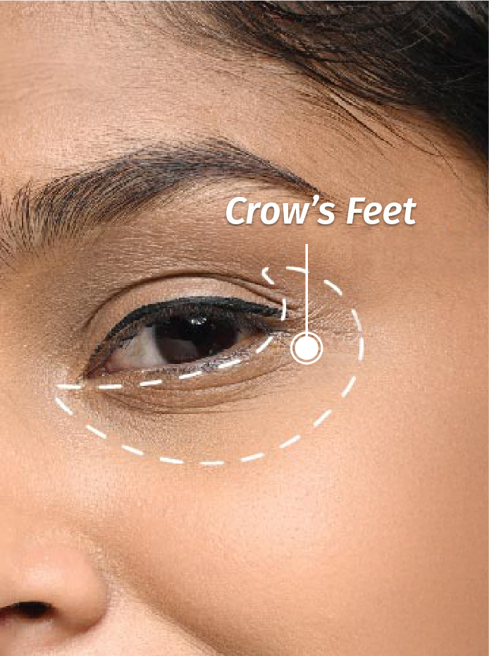 crow's feet