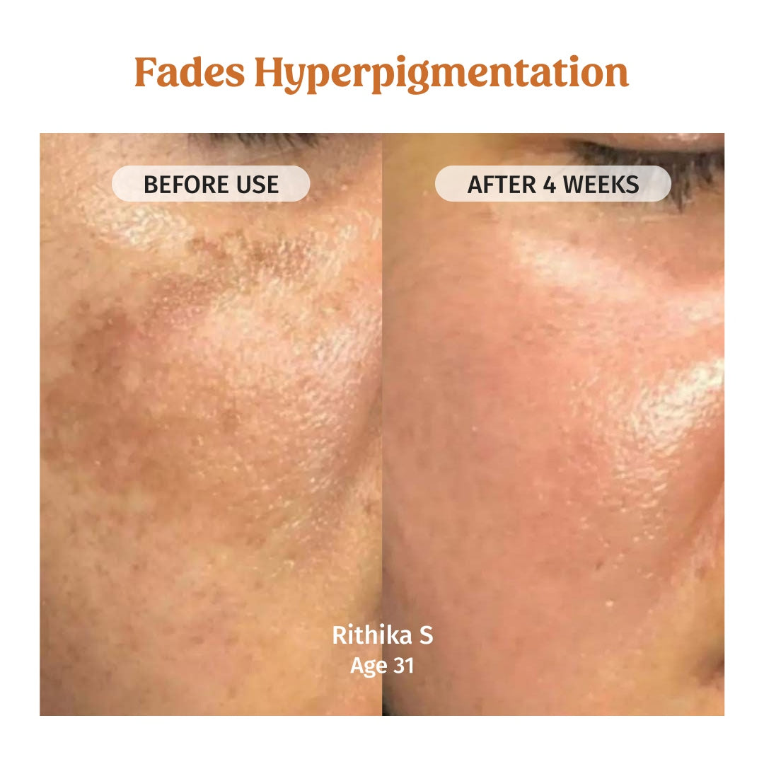 Vilvah Face Brightening Combo fades hyperpigmentation