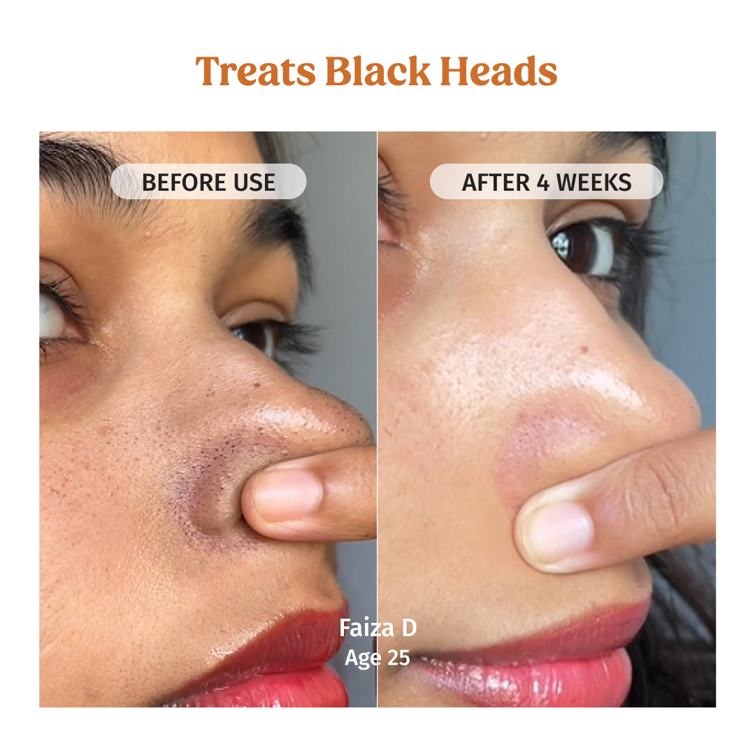 Vilvah Face Brightening Combo treats Blackheads