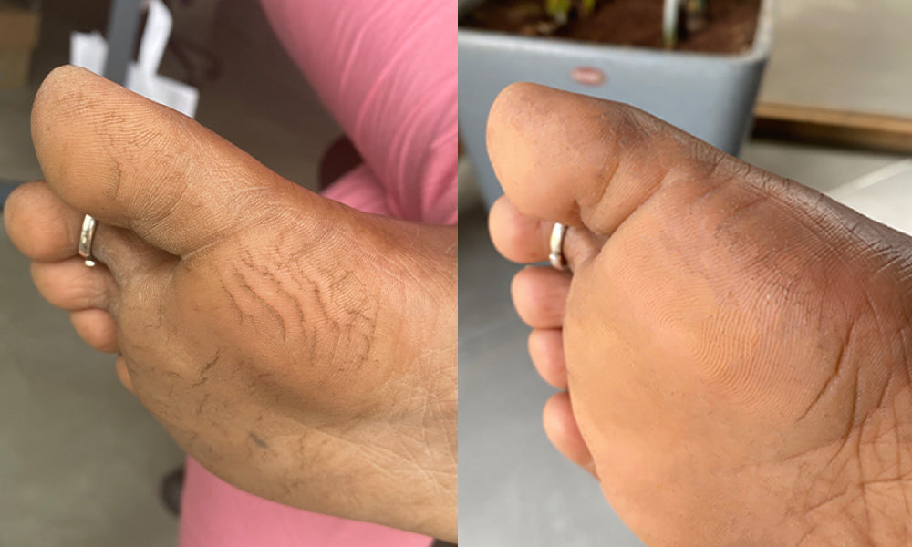 Before and after using foot crack cream - Vilvah