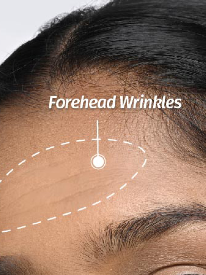 forehead wrinkles
