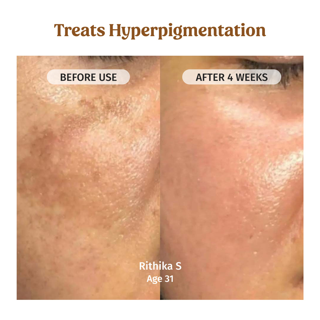 before and after using milk drops brightening serum - treats hyperpigmentation