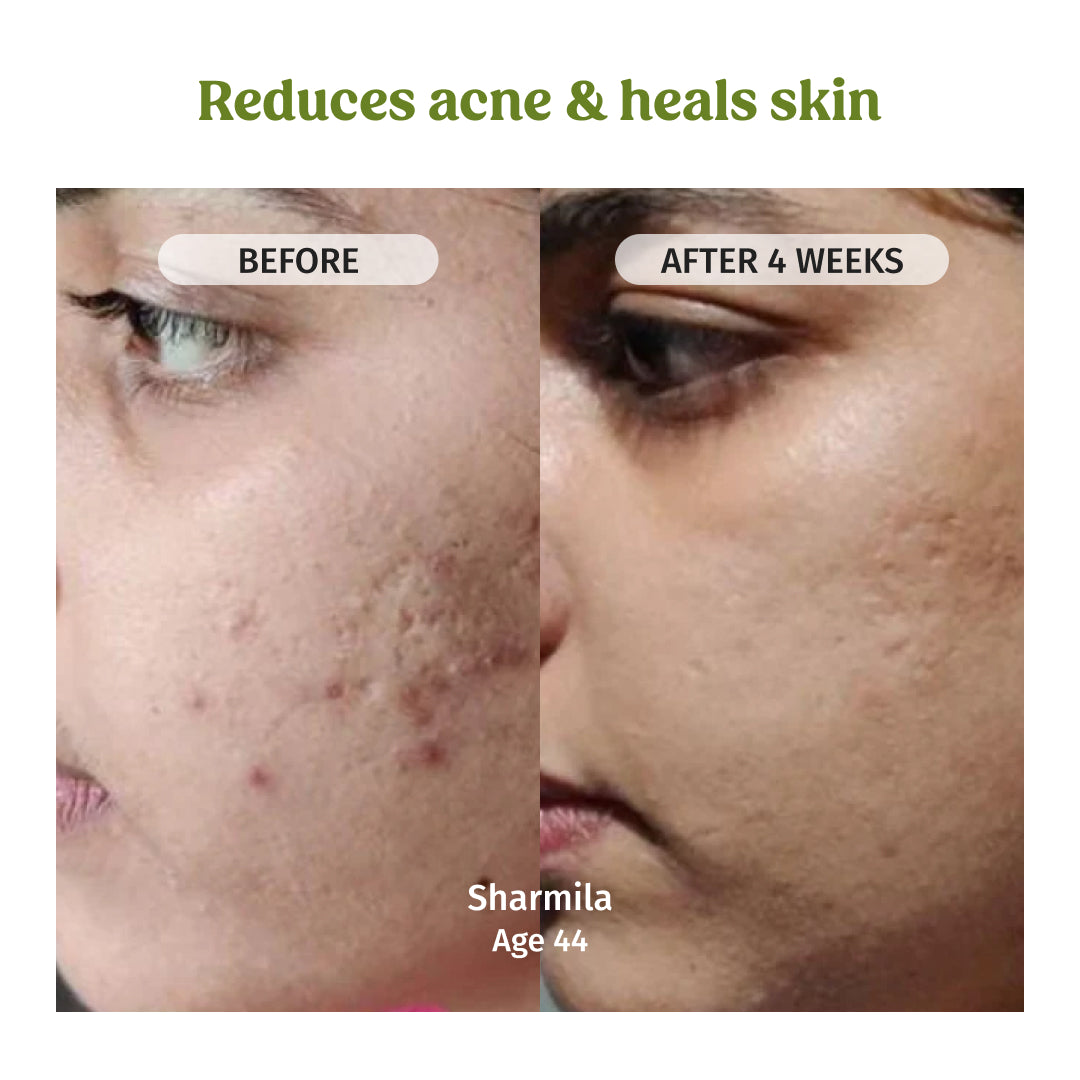 vilvah aloe vera gel reduces acne and heals skin