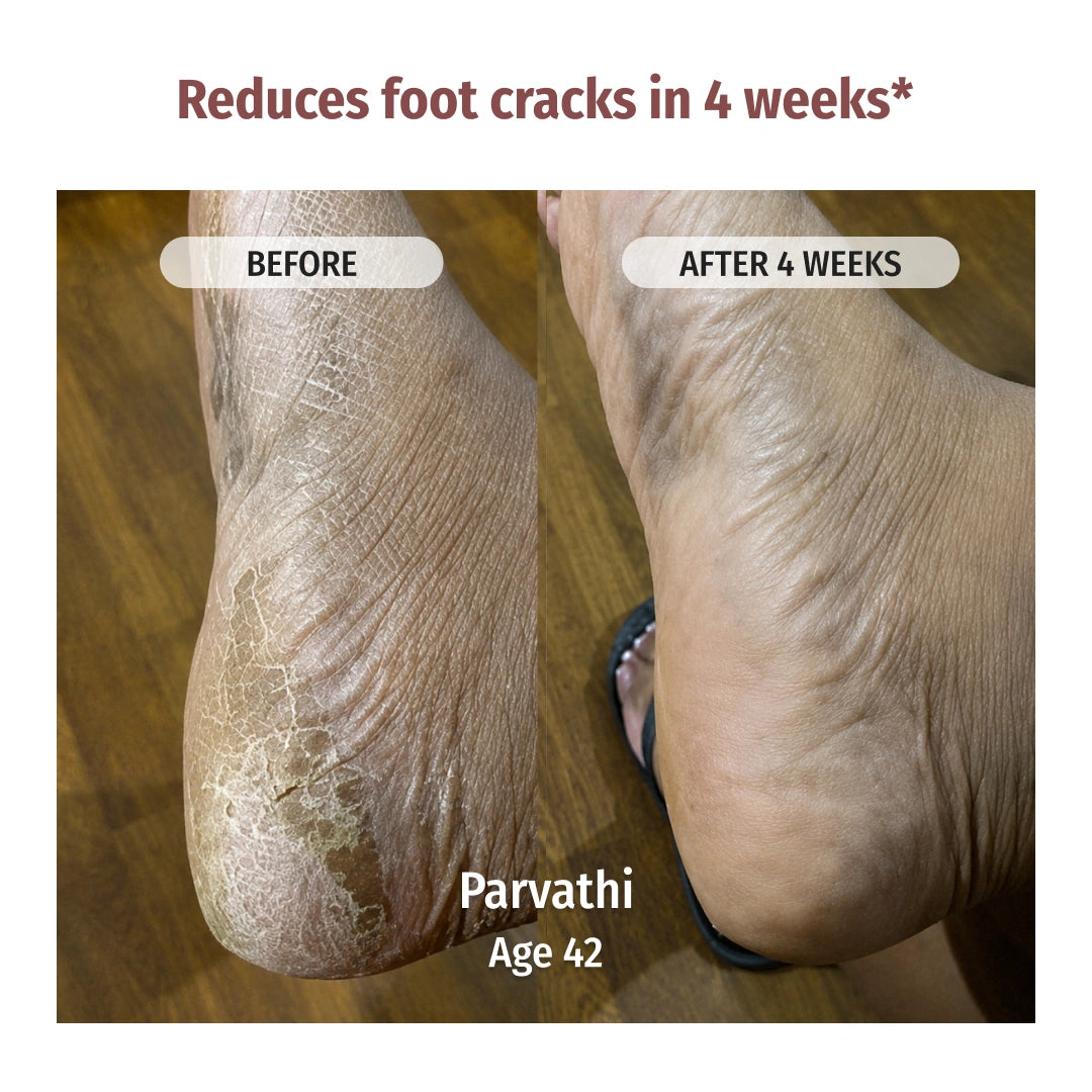 Vilvah Foot Cream and Body Lotion Combo reduces Foot Cracks