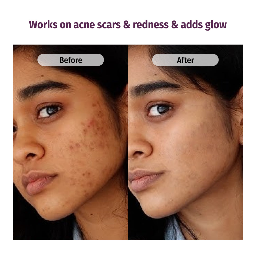 vilvah honey fix face wash reduces acne scars and redness and adds glow