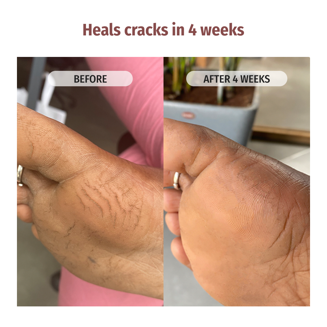 vilvah foot cream heals cracks in 4weeks
