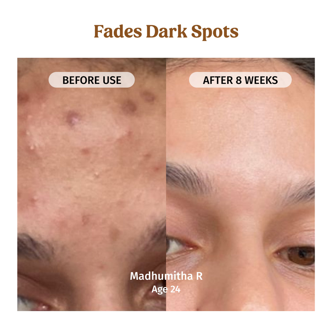 before and after using milk drops brightening serum - fades dark spots