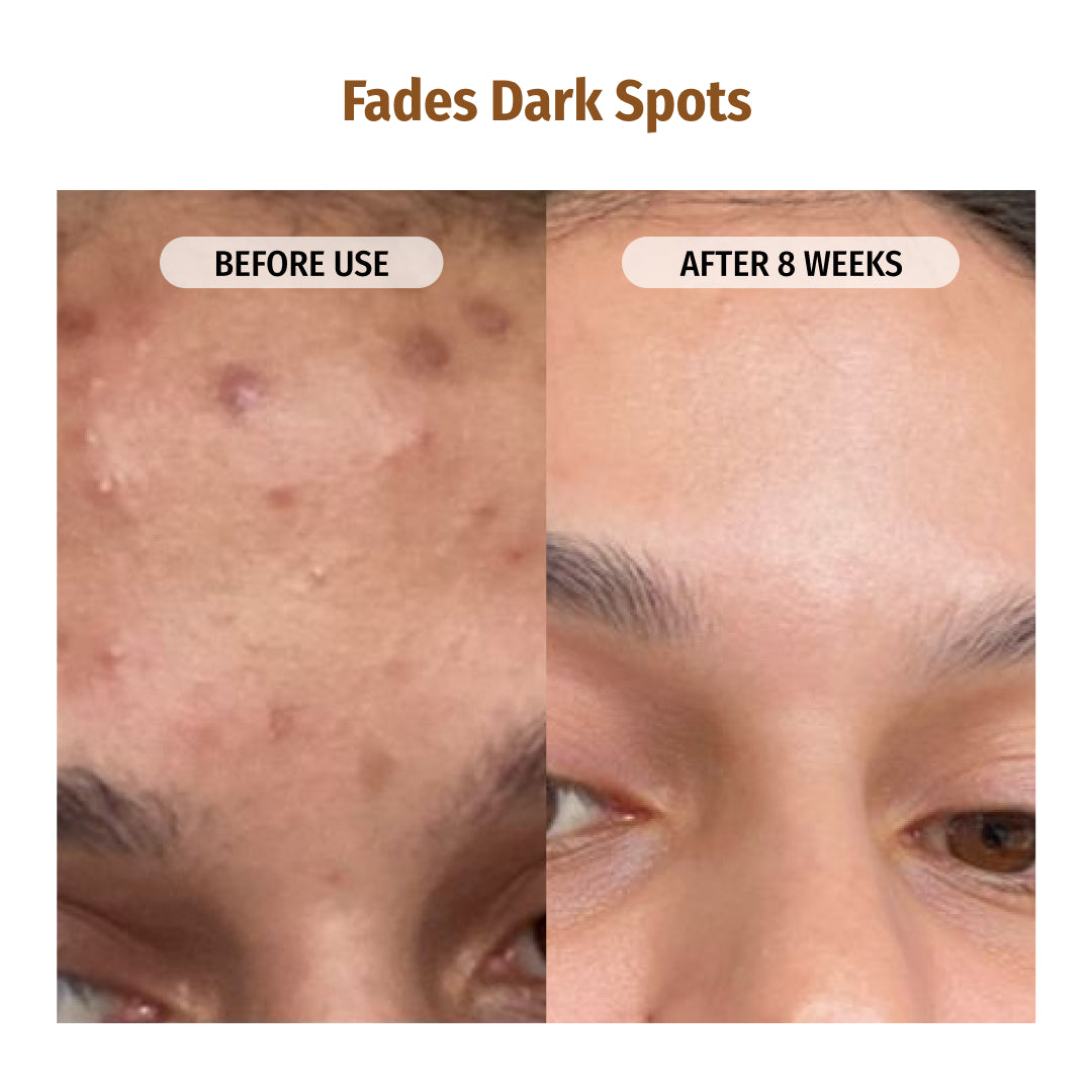 Vilvah Skin Brightening Combo Fades Dark Spots