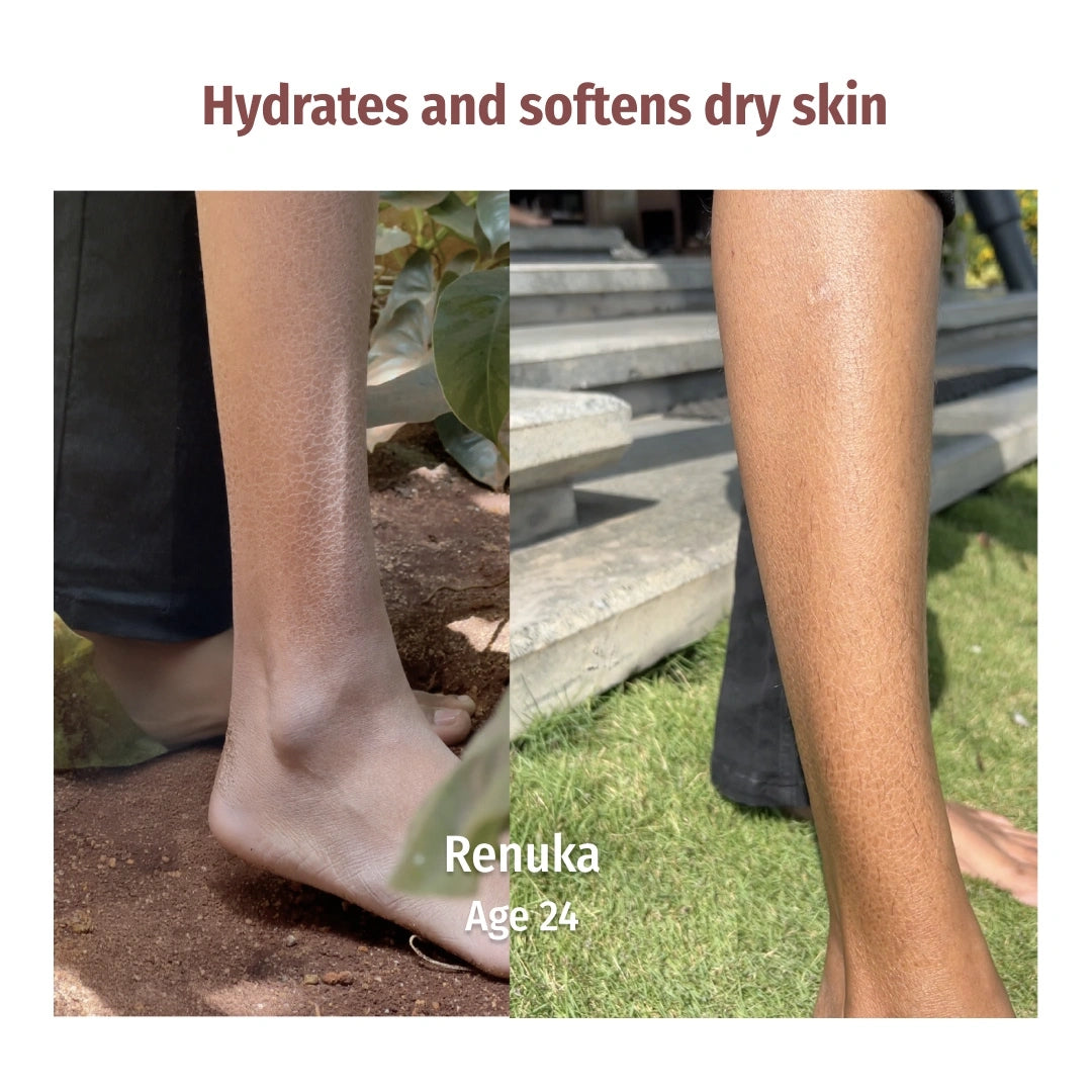 Vilvah Foot Cream and Body Lotion Combo hydrates and softens dry skin