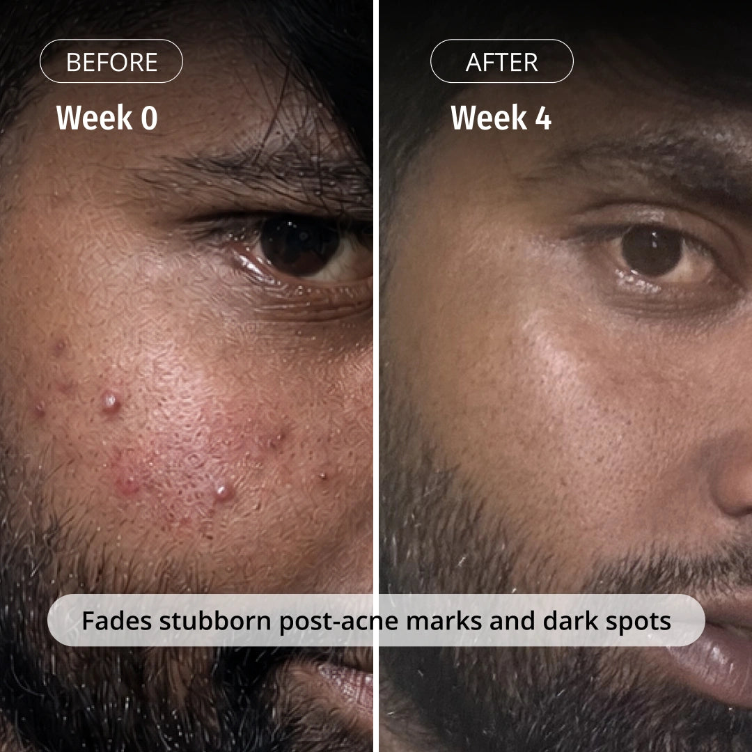 Vilvah Milk Drops Serum fades stubborn post-acne marks and dark spots