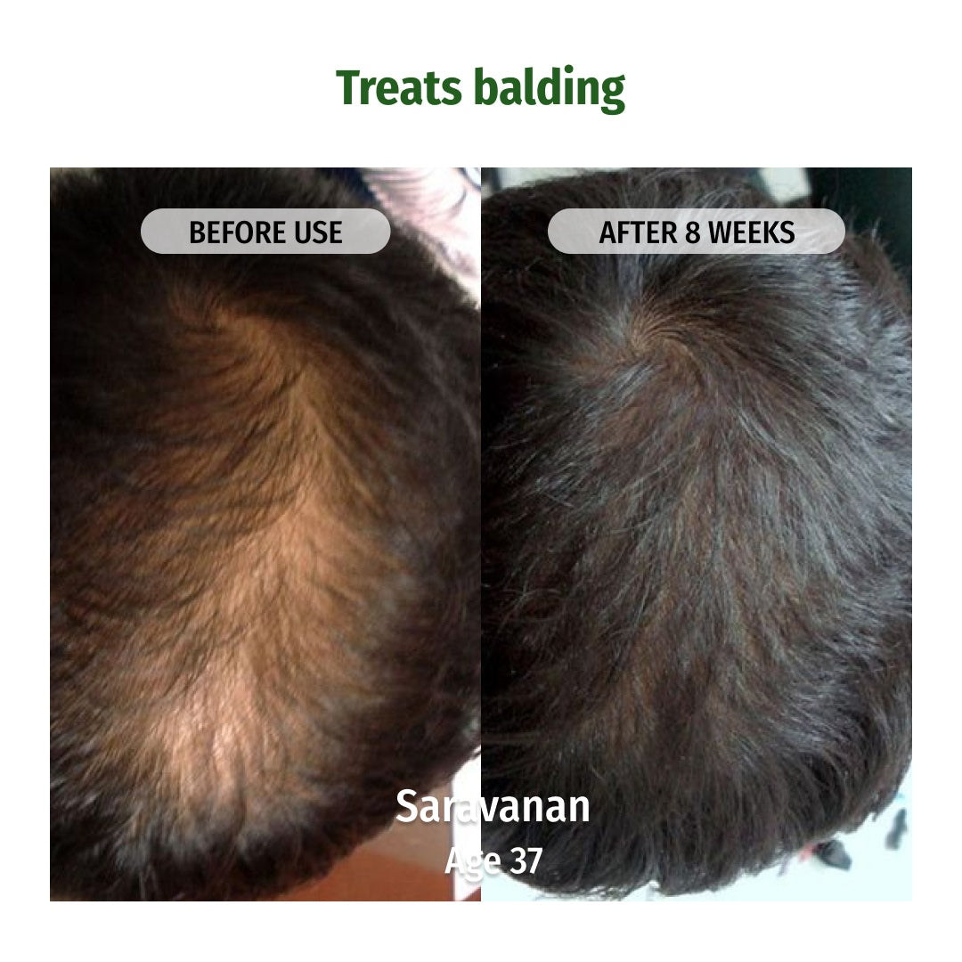 vilvah hair regrowth oil treats balding