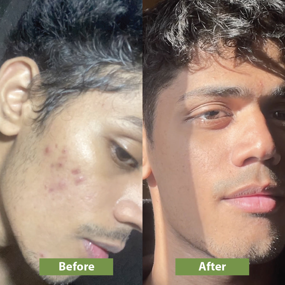 Before and after using milk face combo - Vilvah