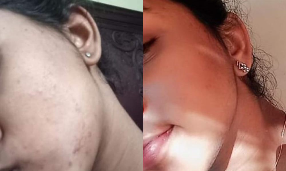 Before and after using Vilvah's royal ubtan