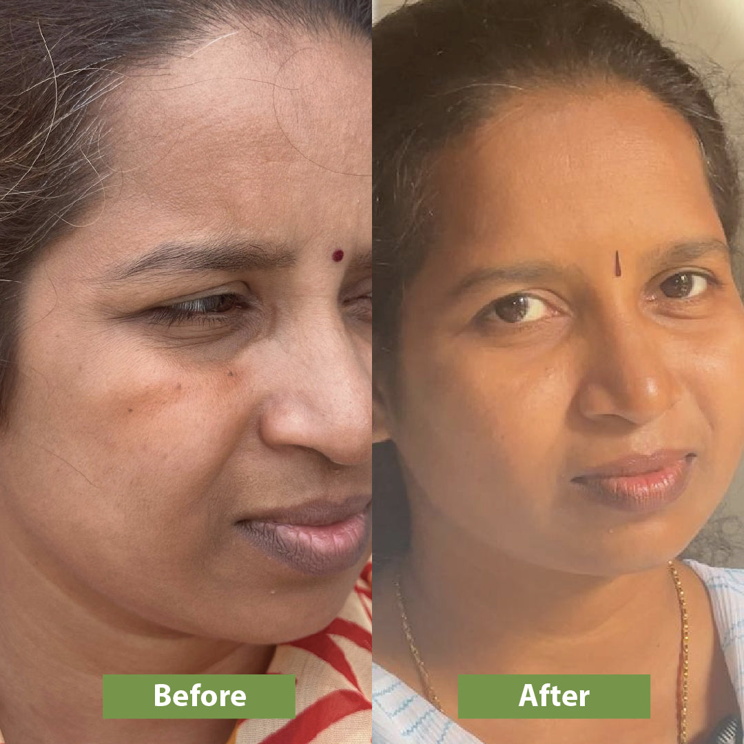 Before and after using milk drops brightening serum - Vilvah