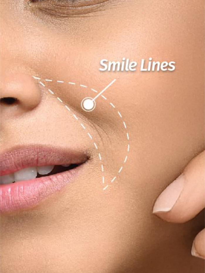 smile lines