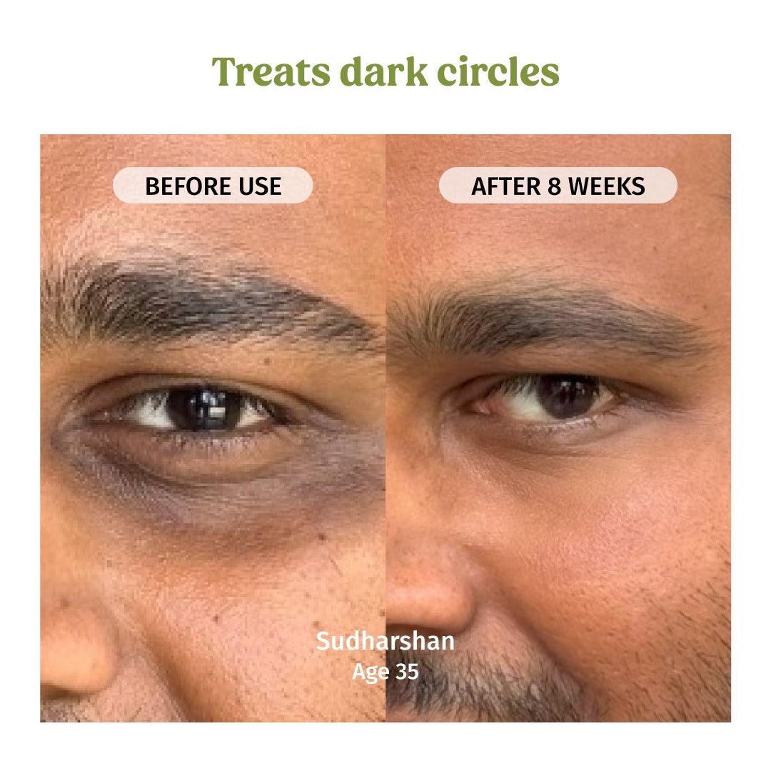 vilvah under eye cream treats dark circles