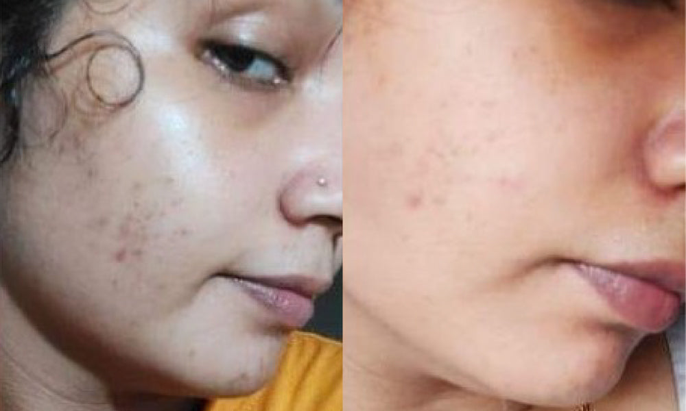 Before and after using Vilvah's wild rose face mask