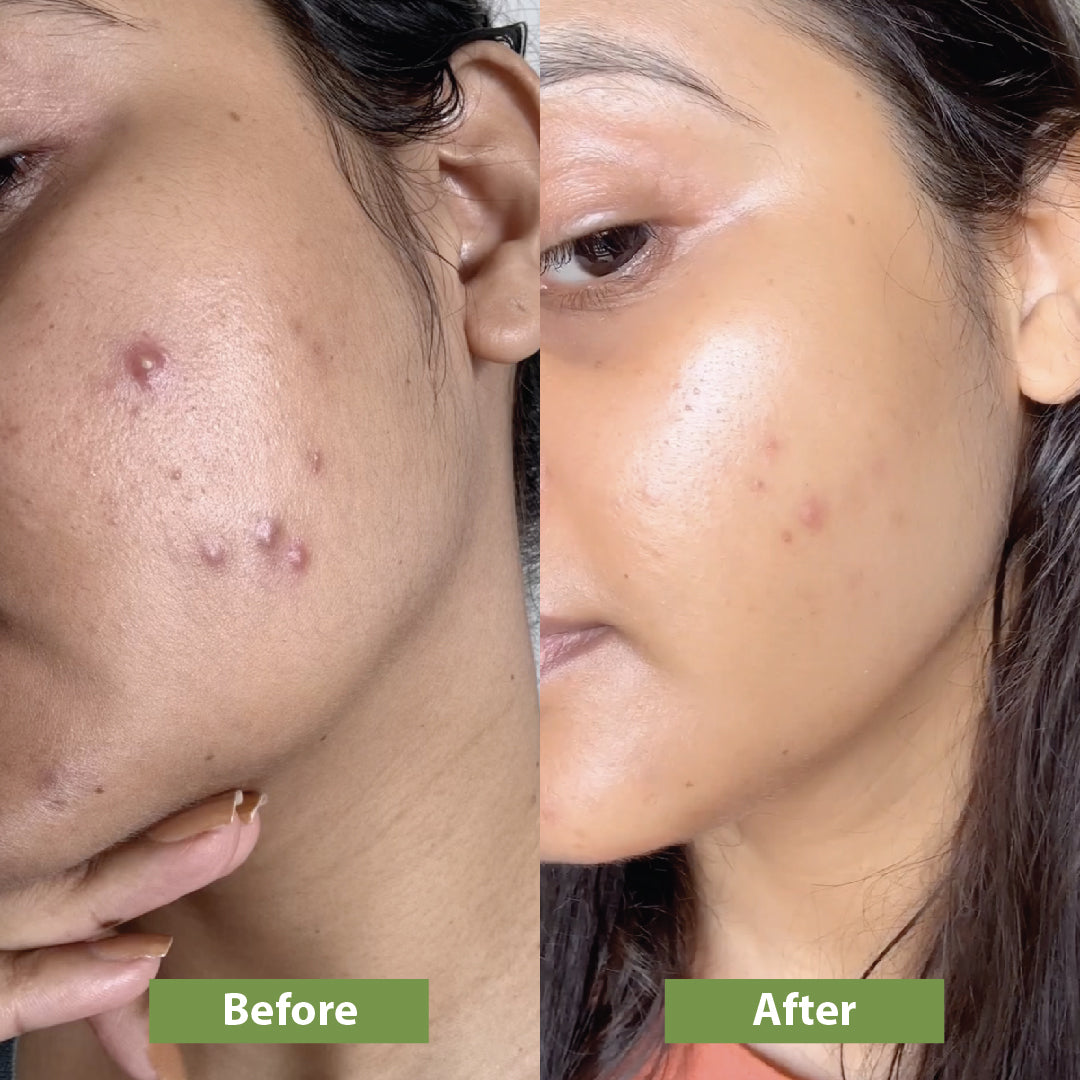 Before and after using Vilvah's anti-acne combo