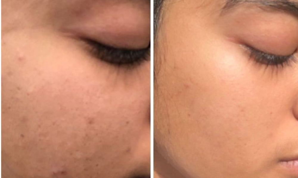 Before and after using milk powder face wash - Vilvah