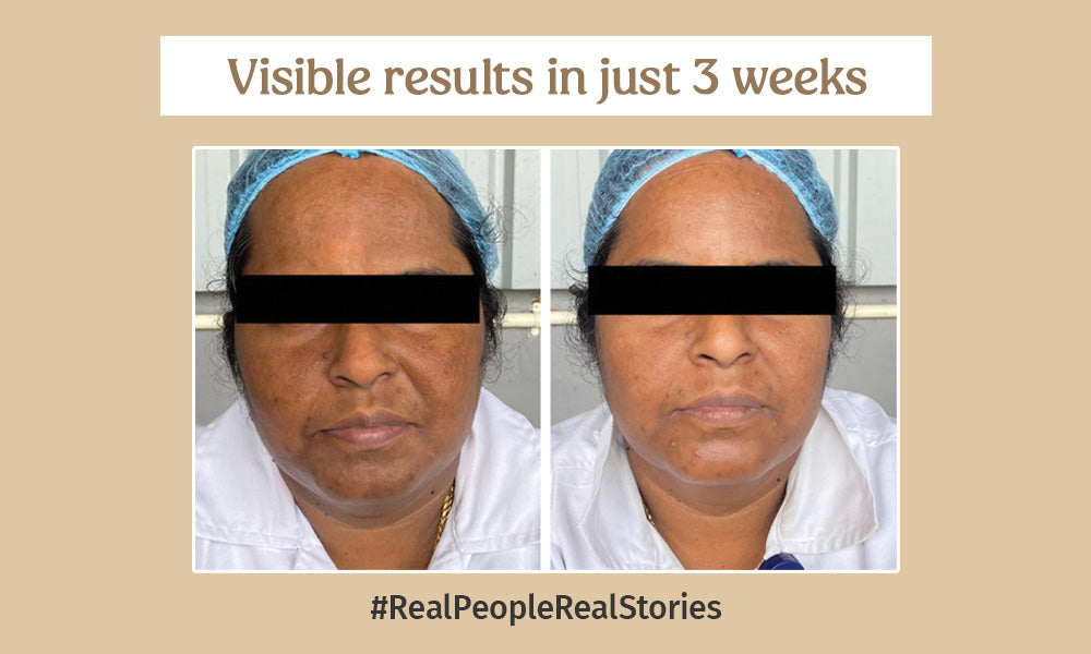 Before and after using Vilvah milk face combo