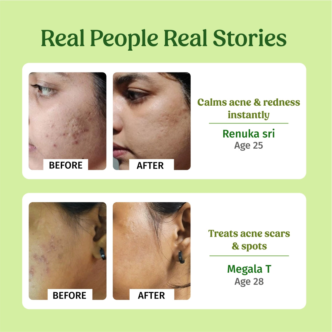 aloe vera gel for acne scars before and after