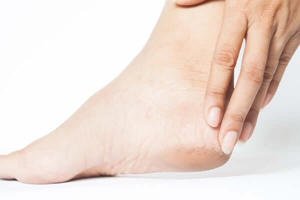 Why should you use foot crack creams for your cracked heels?