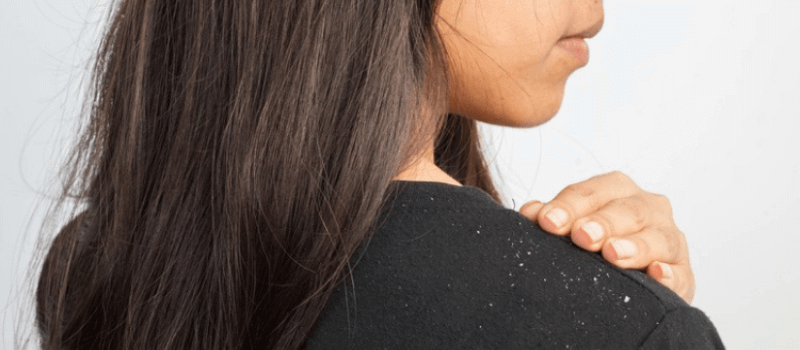 Causes of dandruff and Ways to prevent it