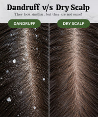 Dandruff v/s Dry Scalp: Understand the Real Difference