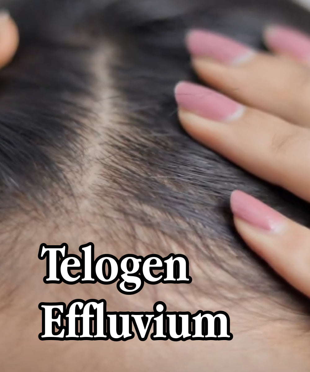 telogen effluvium