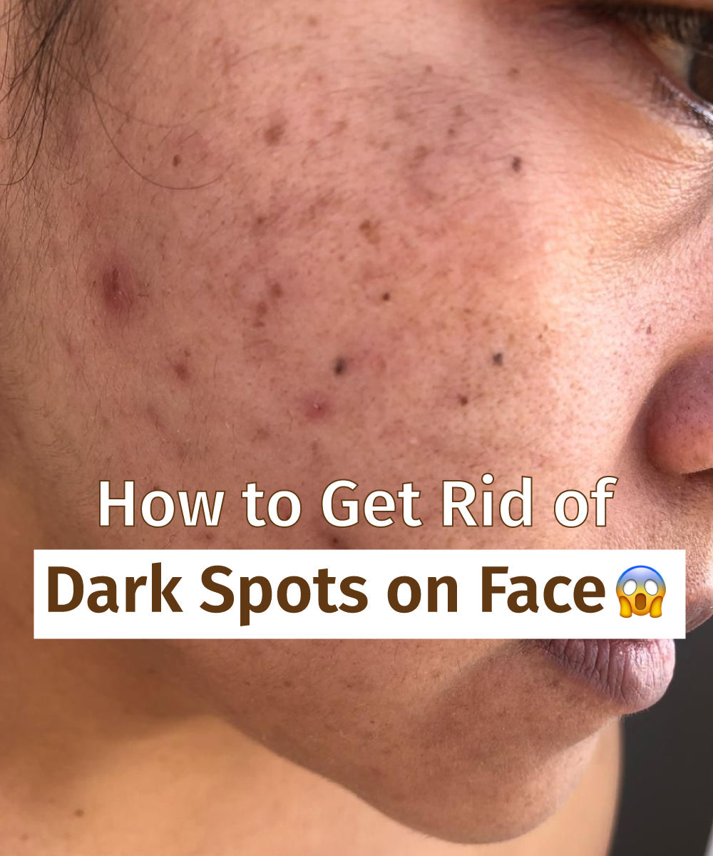 how to remove dark spots on face