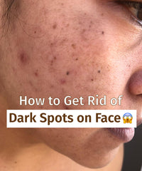 How To Get Rid Of Dark Spots On Face?