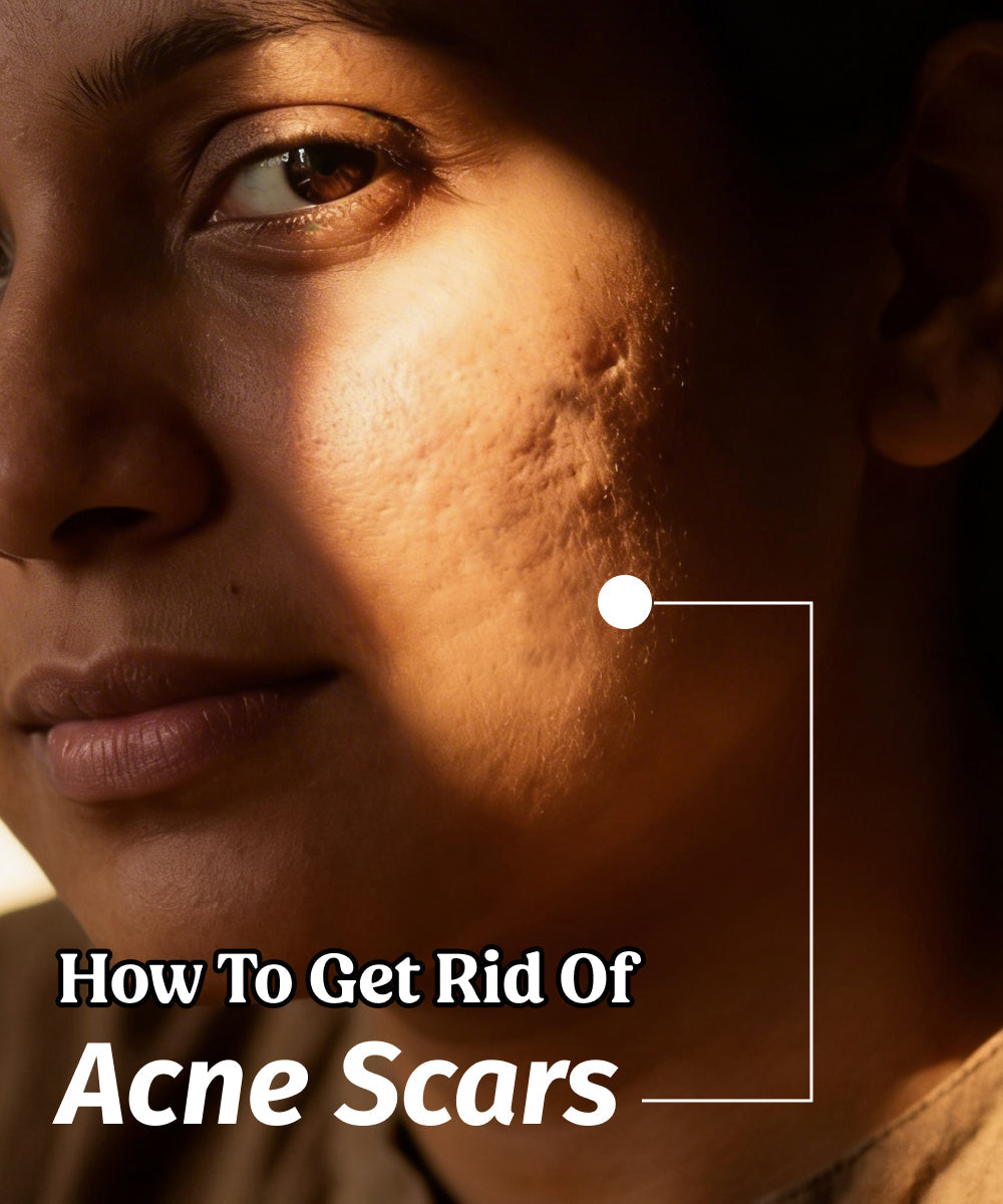 how to reduce acne scars and marks