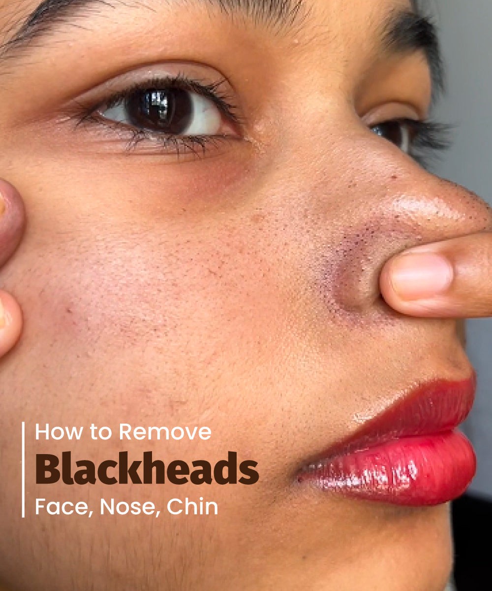 how to remove blackheads