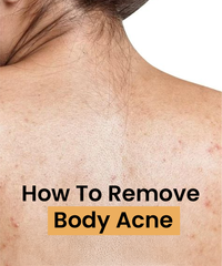 6 Simple Ways To Reduce Body Acne
