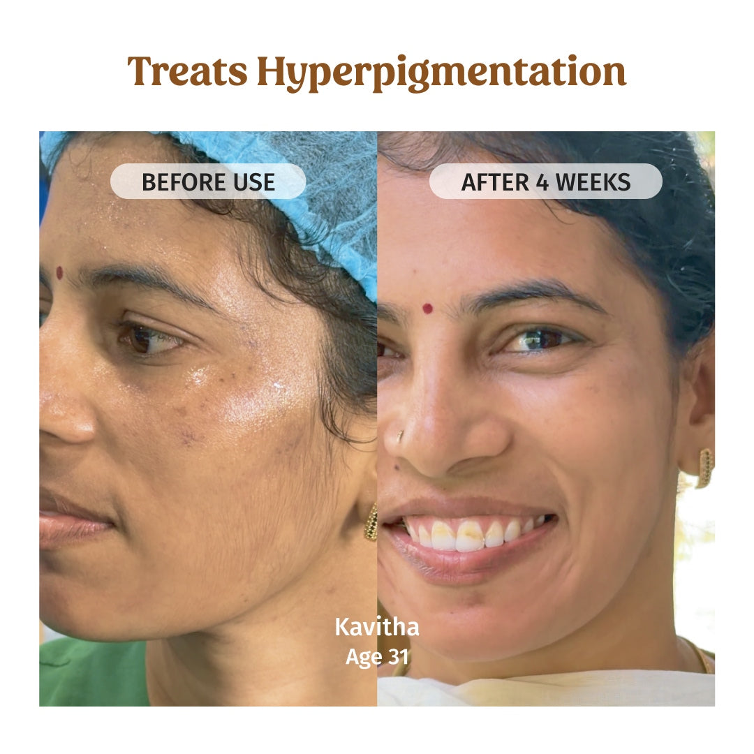 vilvah milk drops serum treats hyperpigmentation