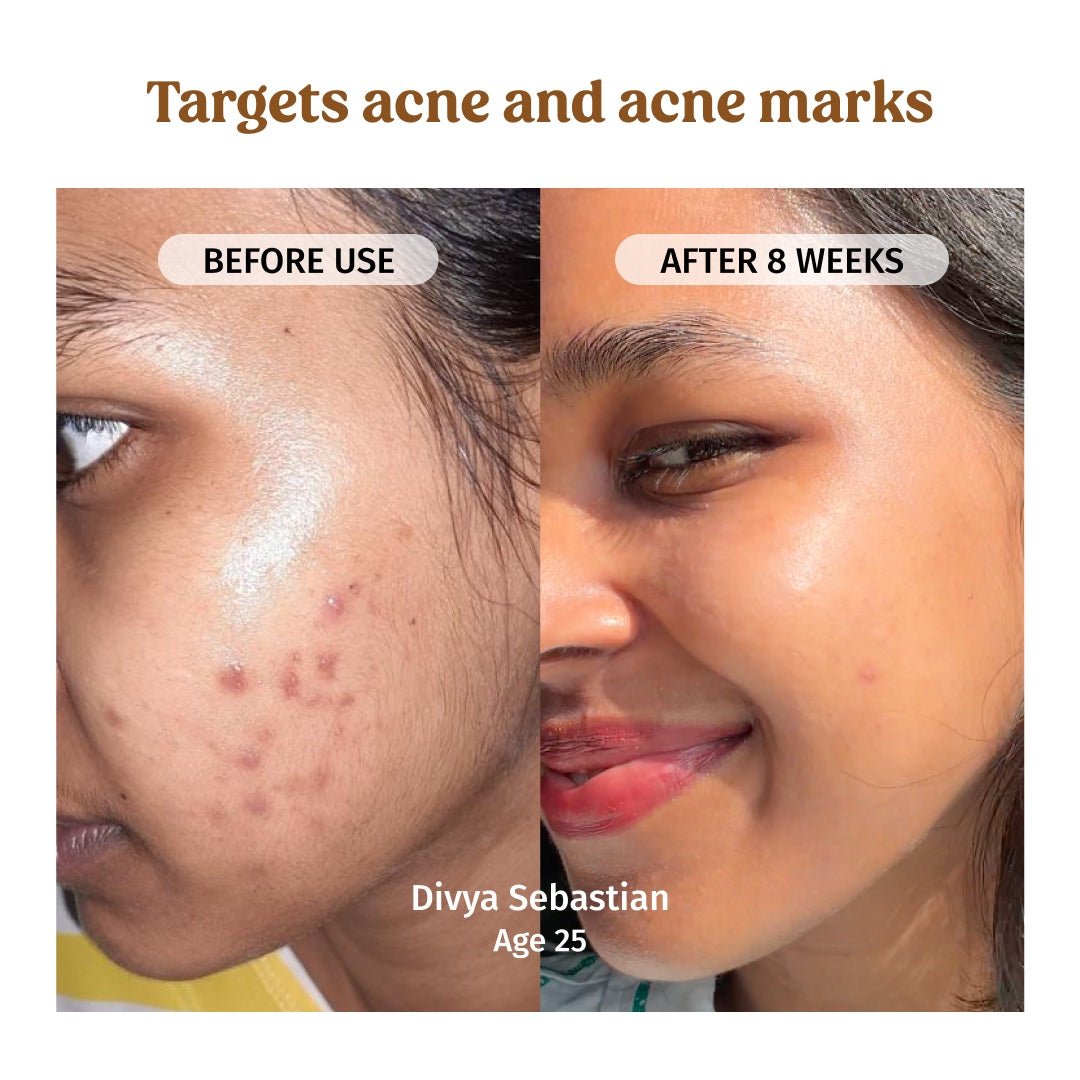 vilvah milk drops serum targets acne and acne marks